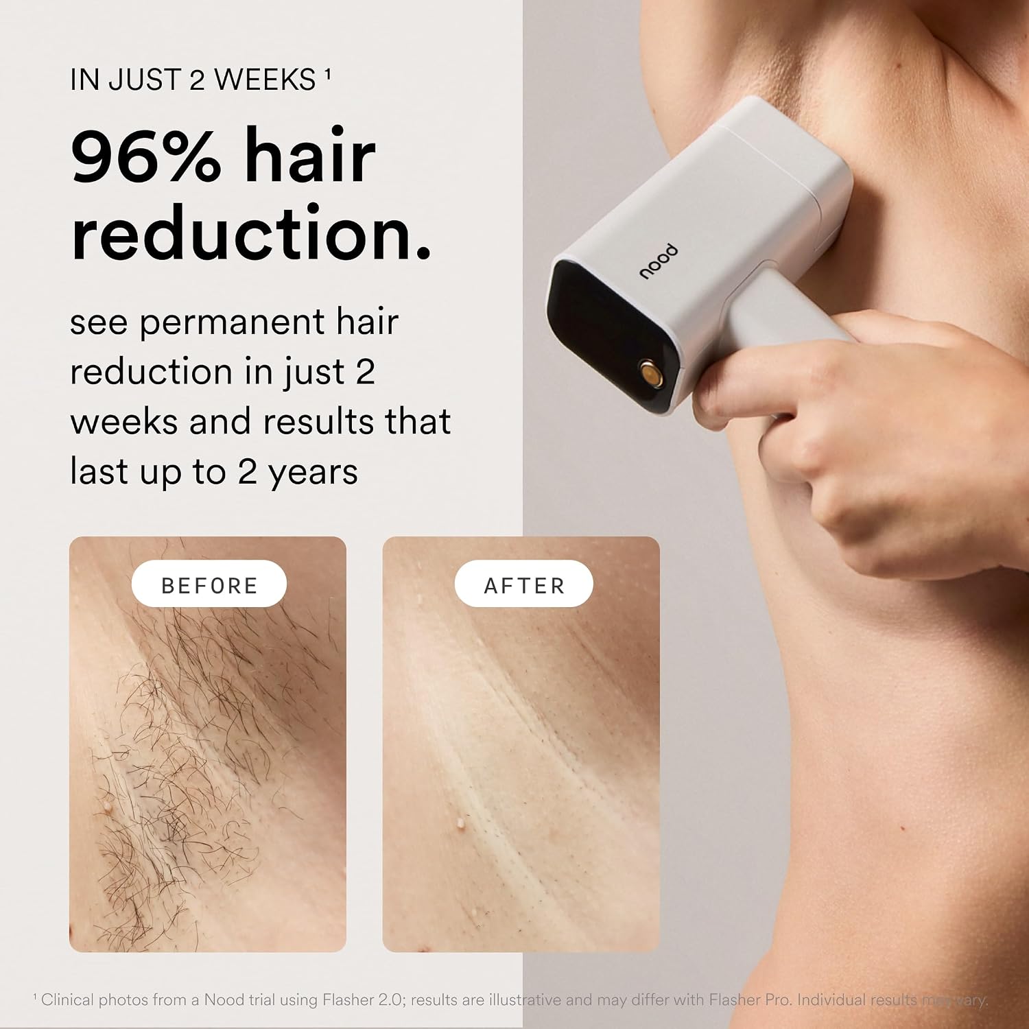 Nood™ Flasher Pro Kit | IPL Laser Hair Removal Device with Pre/Post Care - Image 3