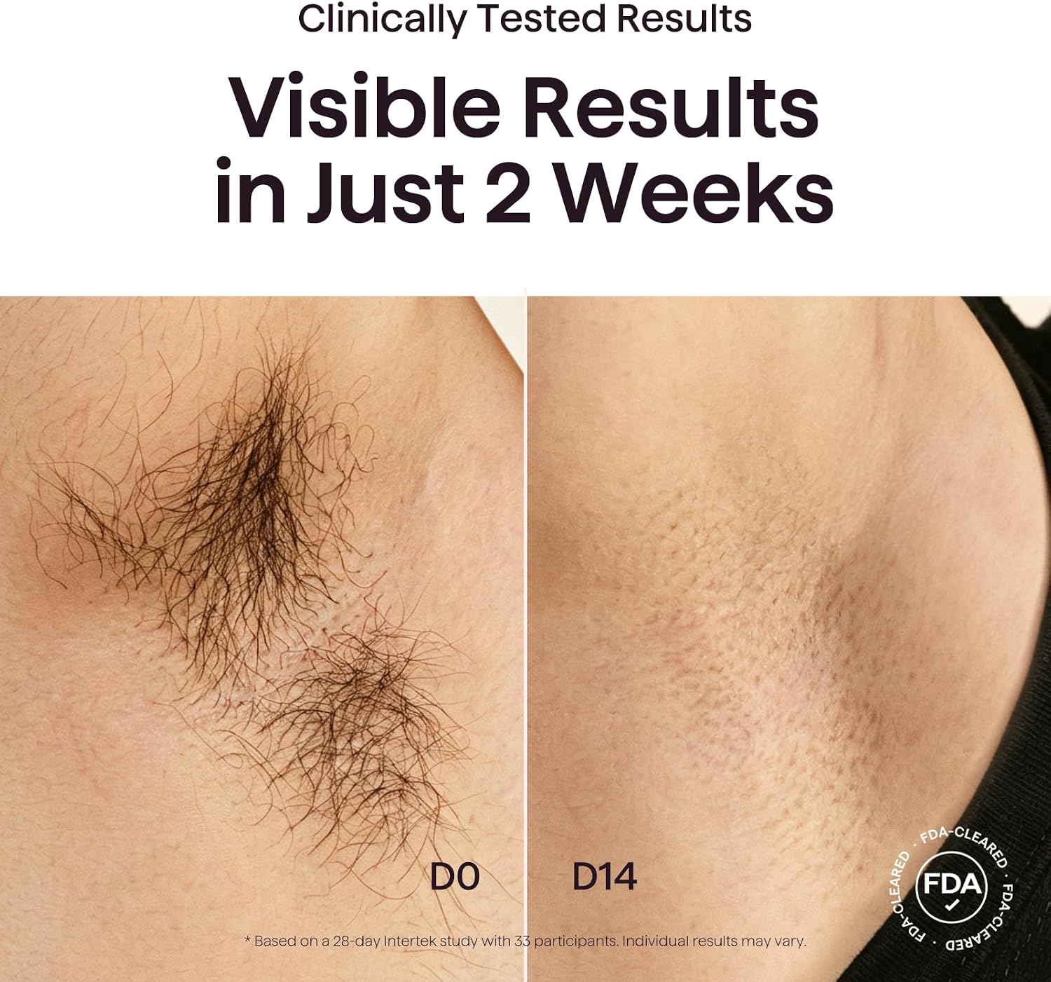 Wavytalk IPL Laser Hair Removal,Bare It with Precision Roller for Full Body - Image 3